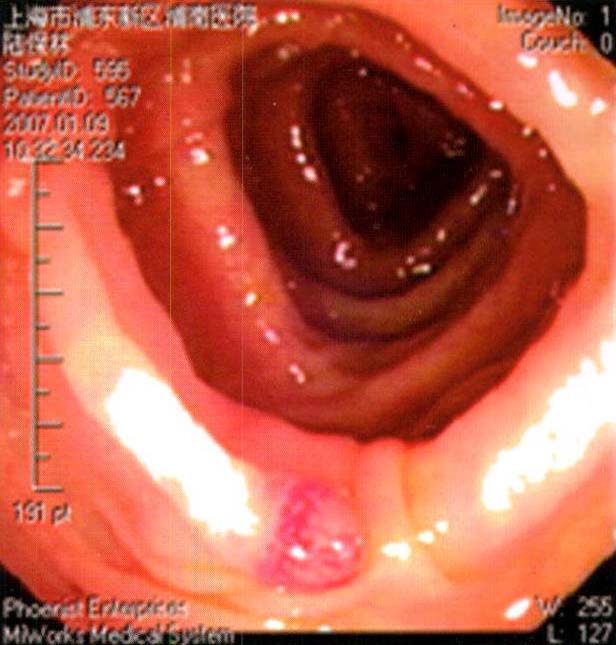 三、纖維結腸鏡檢查